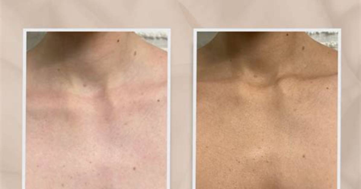Before and After Bronzed By