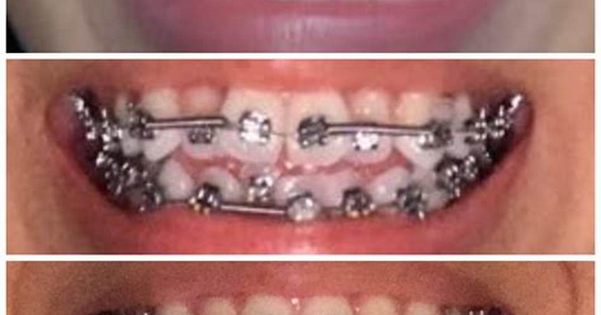 Braces Power Chain Before and After Real Gap Closing Results and Color
