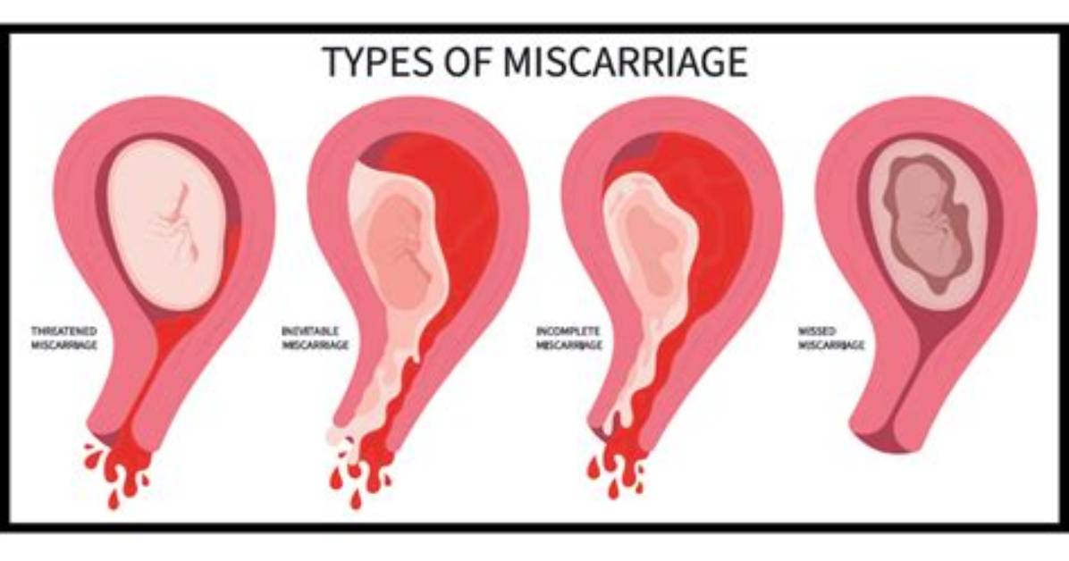 Can Lady Bloom Cause Miscarriage the Dangerous Truth Behind Herbal