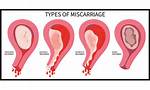 Can Lady Bloom Cause Miscarriage? the Dangerous Truth Behind Herbal Pregnancy Rumors