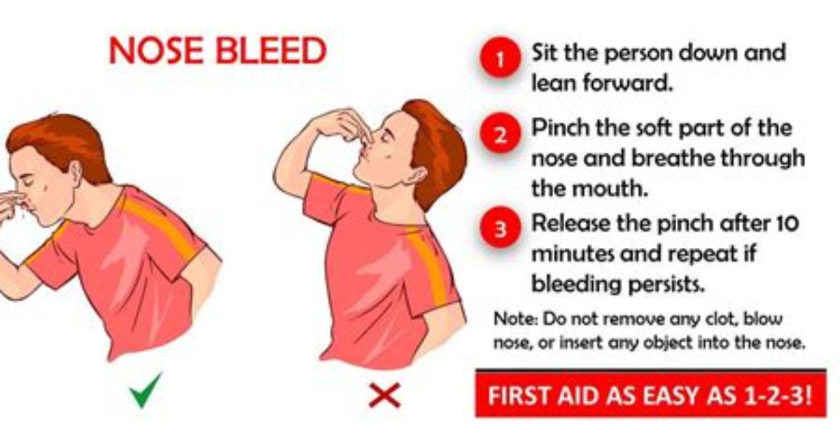 Can You Safely Force a Nosebleed Medical Experts Debunk The