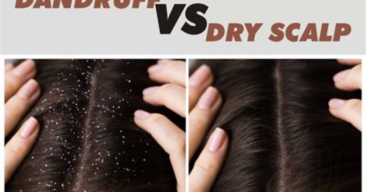Dandruff vs Dry Scalp on Bald Heads Dermatologists Settle The