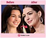 Did Anne Hathaway Get Botox? the Star Breaks Her Silence on 'Distracting' Cosmetic Rumors