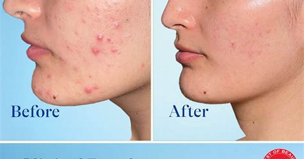 Differin Gel Before and After 30 60 and 90 Day Real User