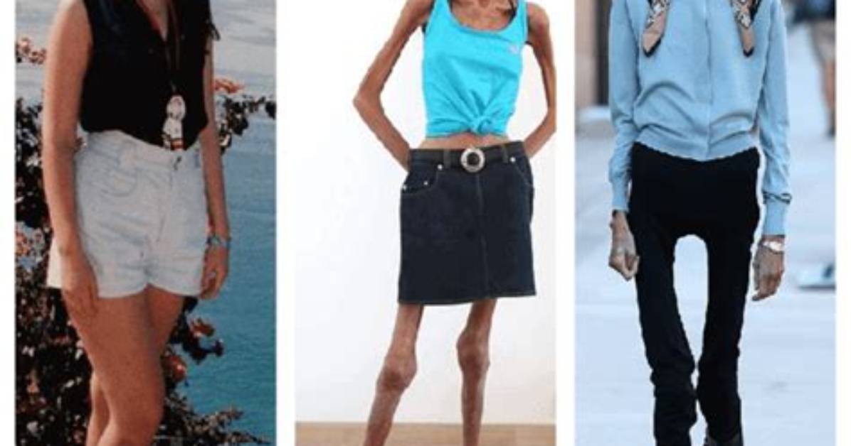 Fact Checking the World S Skinniest Person Unmasking Viral Images And