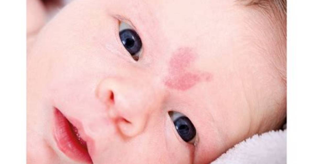 Is a Stork Bite Really a Warning Sign of Mthfr Mutation Viral