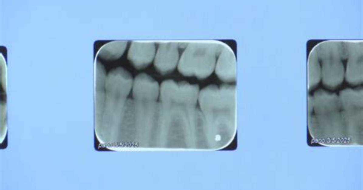 Madison Marks 12 Months Without Water Fluoride as Dental