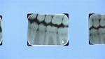 Madison Marks 12 Months Without Water Fluoride as Dental Warnings Escalate
