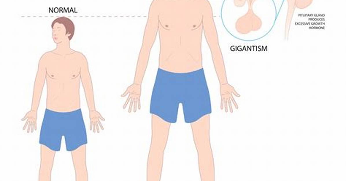 Medical Breakdown What Pituitary Gigantism Actually Does to The