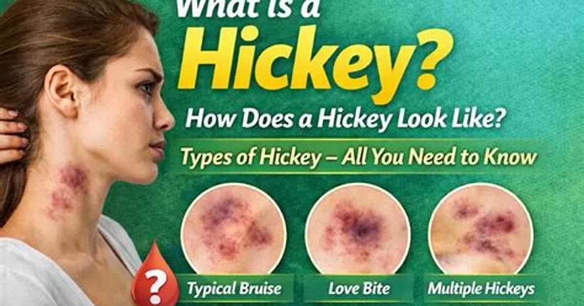 Medical Truth Behind Hickeys Broken Blood Vessels Health Myths And
