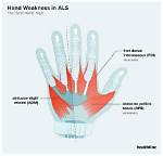 New Clinical Warnings on Hand Weakness: When Slipping Grip Signals Serious Nerve Trouble