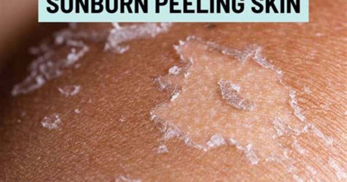 Should You Peel Shedding Sunburn Skin Dermatologists Debunk The