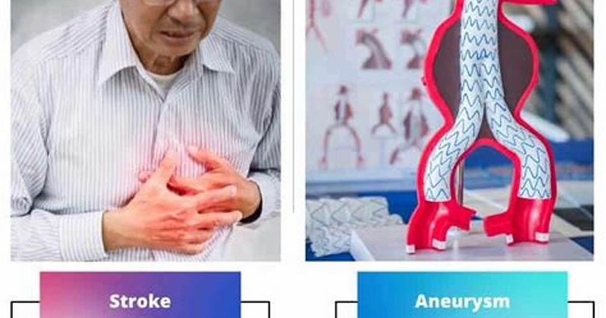 Stroke vs Aneurysm on Scans How Doctors Spot the Difference