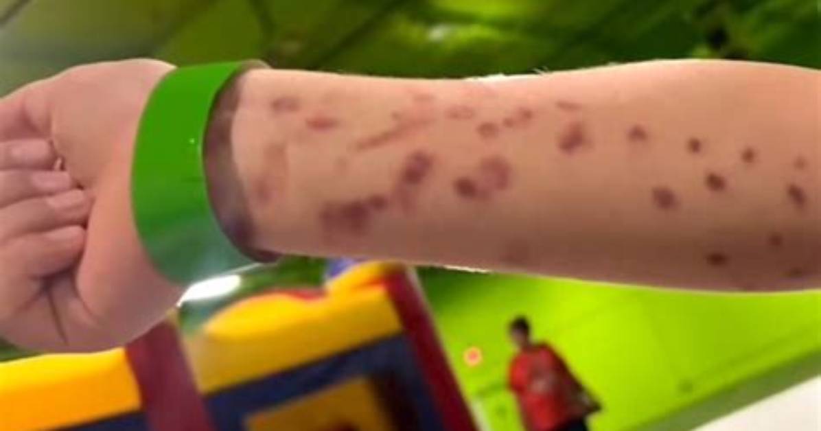 The Science of Suction Bruises Debunking Viral Hickey