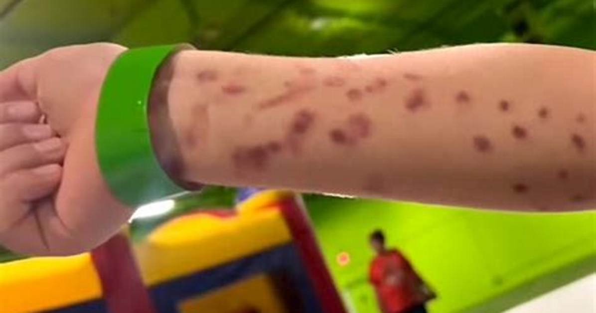 The Science of Suction Bruises Debunking