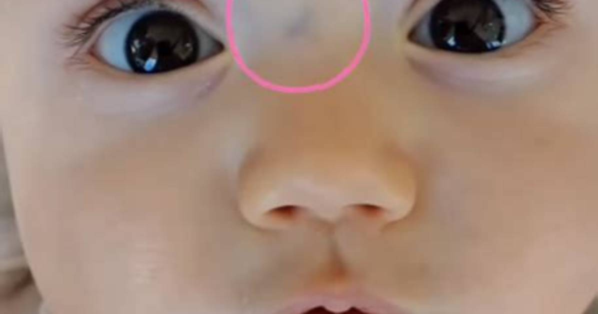 The Sugar Bug Vein Myth Why Social Media Claims About Your Baby S Nose Are Causing