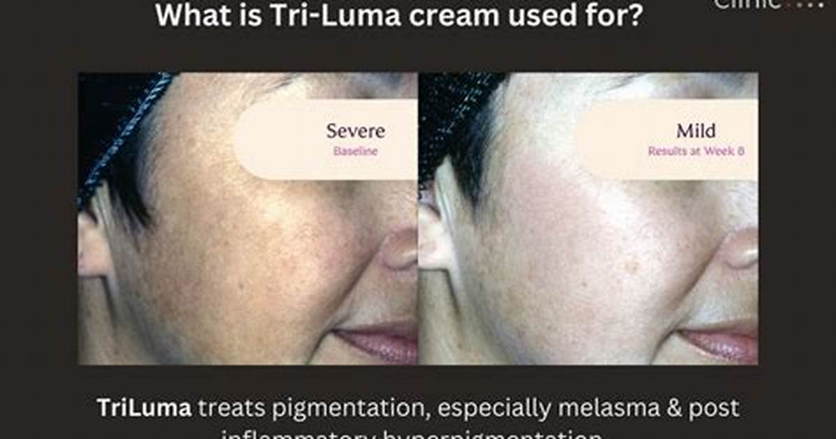 Tri Luma Cream Before and After Clinical Results On