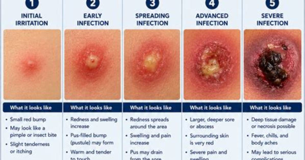 What Early Staph Looks Like Key Visual Indicators and Skin