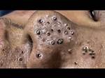 Why the Newest 2025 Nguyen Blackhead Removal Videos Are Going Insanely Viral